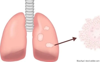 Sarkoidose | Lungensarkoidose